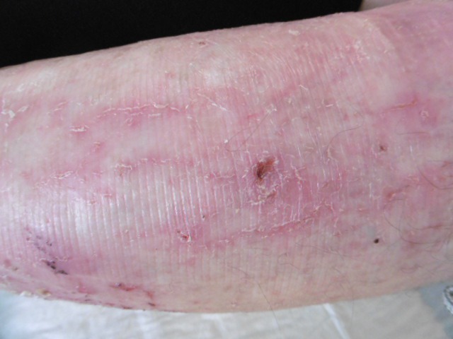 eczema craquelé