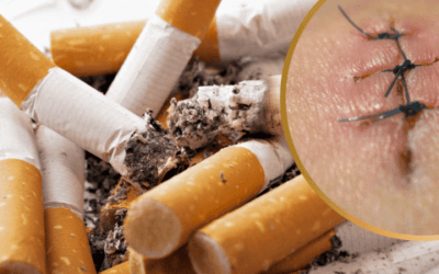 4 conseils pour mieux prévenir les effets néfastes du tabac sur la cicatrisation