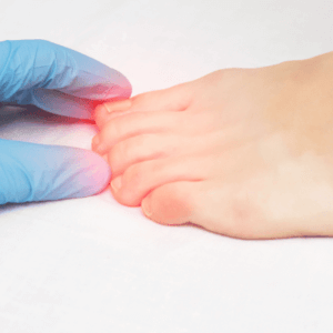 stratégies et traitements de l'ongle incarné