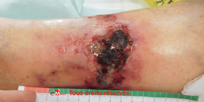 angiodermite nécrotique photo 