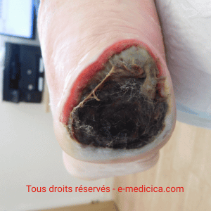 Talon noir : escarre ou ischémie sévère ? Comment poser le bon diagnostic et agir vite