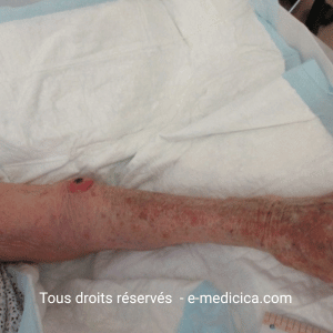 Kératoacanthome : lésion cutanée de croissance rapide et prise en charge