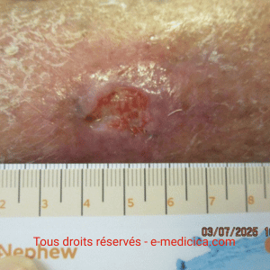 keratoacanthome après biopsie photo 6 keratoacanthome photo jambe après biopsie : plaie en voie de cicatrisation