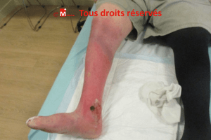 lipodermatosclérose photo avec dermo-hypodermite chronique et ankylose de cheville
