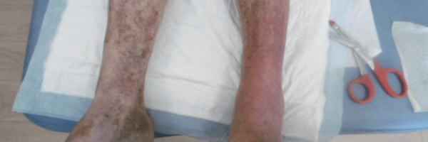 dermite ocre taches jambes