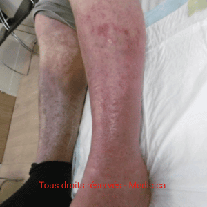 photo dermite ocre jambe