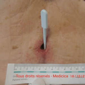 plaie profonde post opératoire au niveau du râchis lombaire
