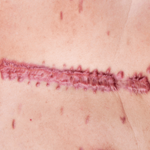 cicatrice chéloïde du sternum photo