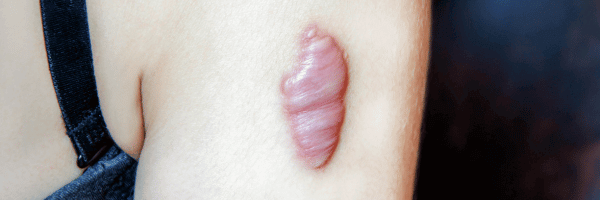 Cicatrice hypertrophique et chéloïde : diagnostic prévention et traitement