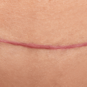 cicatrice hypertrophique sus pubienne photo