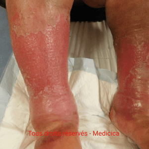 dermite de stase à la phase aiguë aux deux jambes