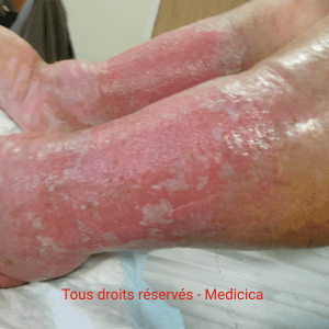 dermite de stase bilatérale de jambe en phase aiguë : érythémato-suintante 