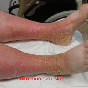 Dermite de stase bilatérale de jambe chronique et sèche