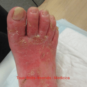 dermite de stase du pied pré ulcéreuse