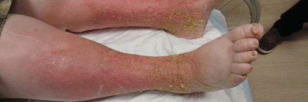 Dermite de stase : définition, diagnostic et prise en charge