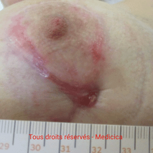 fistule infectieuse avec granulome inflammatoire sous aréole reconstruite fistule infectieuse avec granulome inflammatoire après reconstruction mammaire