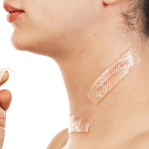 plaque siliconée sur cicatrice photo