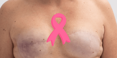 Reconstruction mammaire après cancer : cicatrisation et risques